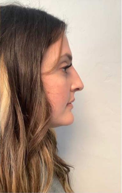 Restylane Before & After Gallery - Patient 131097 - Image 2