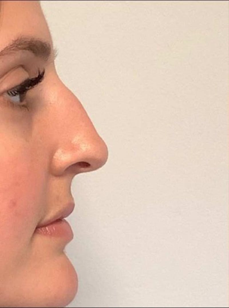 Restylane Before & After Gallery - Patient 131097 - Image 3