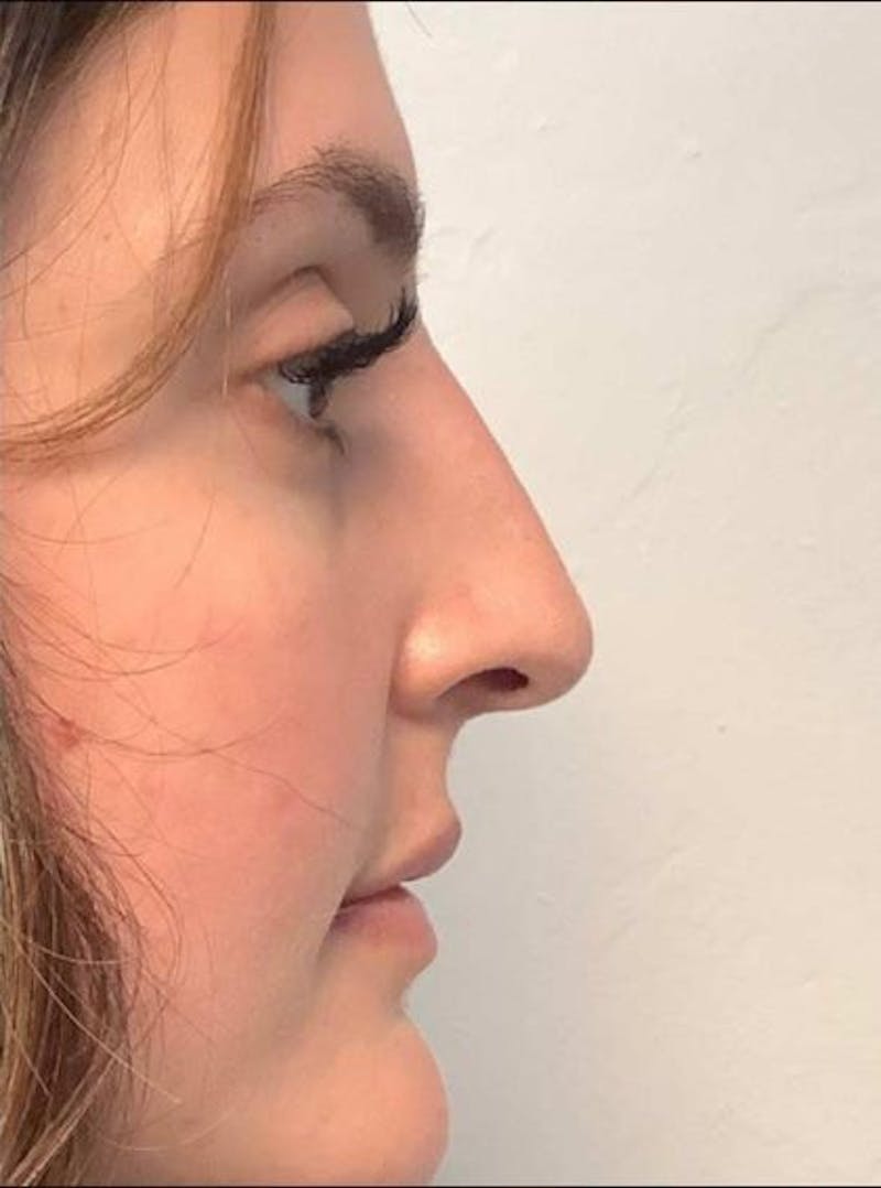 Restylane Before & After Gallery - Patient 131097 - Image 4
