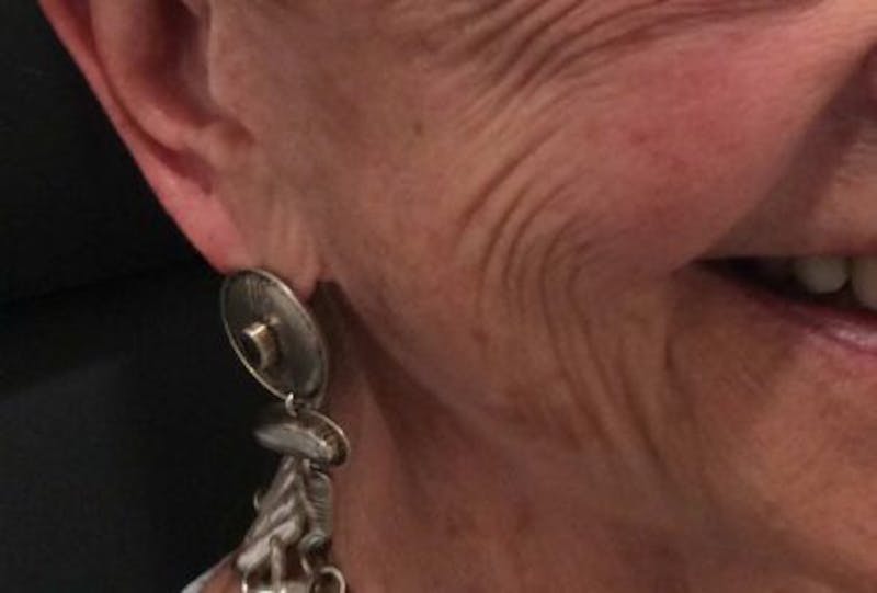 Restylane Before & After Gallery - Patient 338815 - Image 1
