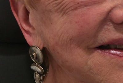 Restylane Before & After Gallery - Patient 338815 - Image 2