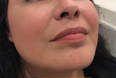 Restylane Before & After Gallery - Patient 118291 - Image 1