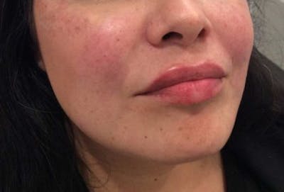 Restylane Before & After Gallery - Patient 118291 - Image 2