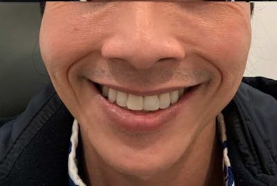 Restylane Before & After Gallery - Patient 698317 - Image 1