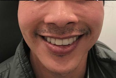 Restylane Before & After Gallery - Patient 698317 - Image 2