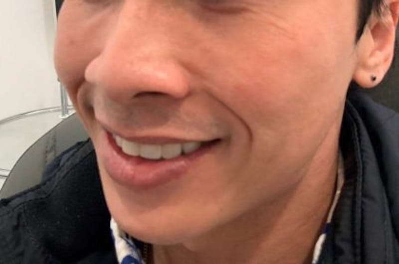 Restylane Before & After Gallery - Patient 698317 - Image 3