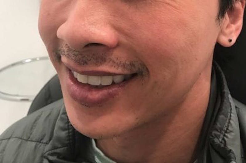 Restylane Before & After Gallery - Patient 698317 - Image 4