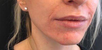 Restylane Before & After Gallery - Patient 555601 - Image 1