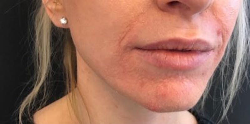 Restylane Before & After Gallery - Patient 555601 - Image 1