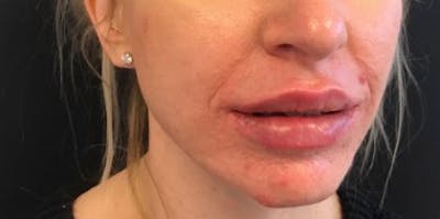 Restylane Before & After Gallery - Patient 555601 - Image 2