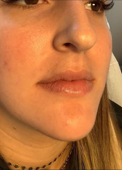 Restylane Before & After Gallery - Patient 762835 - Image 1
