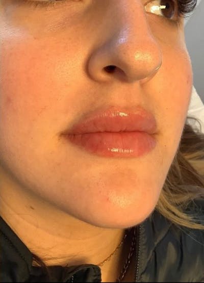 Restylane Before & After Gallery - Patient 762835 - Image 2