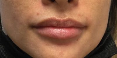 Restylane Before & After Gallery - Patient 393003 - Image 1