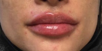 Restylane Before & After Gallery - Patient 393003 - Image 2