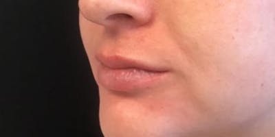 Restylane Before & After Gallery - Patient 367886 - Image 1