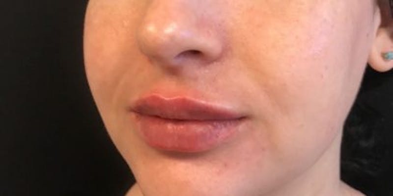 Restylane Before & After Gallery - Patient 367886 - Image 2