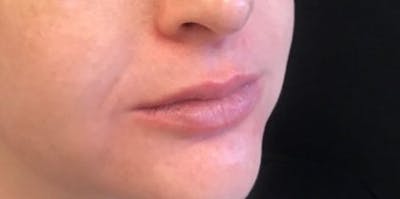 Restylane Before & After Gallery - Patient 416482 - Image 1