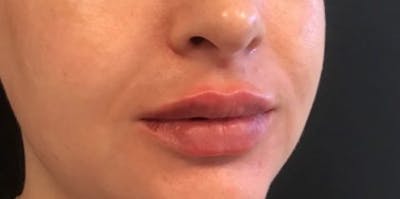 Restylane Before & After Gallery - Patient 416482 - Image 2