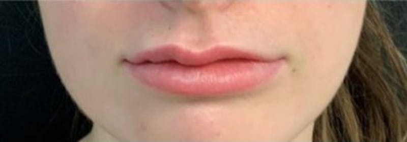 Restylane Before & After Gallery - Patient 509566 - Image 1