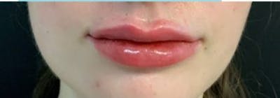 Restylane Before & After Gallery - Patient 509566 - Image 2