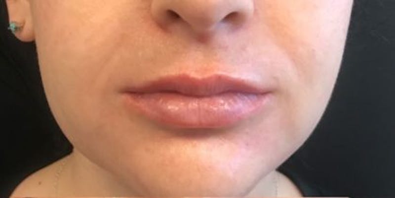 Restylane Before & After Gallery - Patient 271911 - Image 1