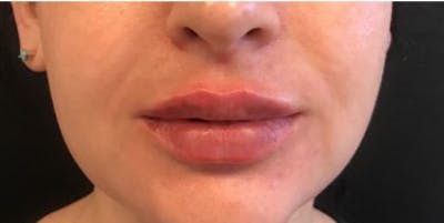 Restylane Before & After Gallery - Patient 271911 - Image 2