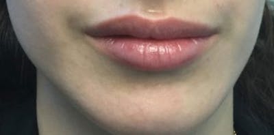 Restylane Before & After Gallery - Patient 100437 - Image 1