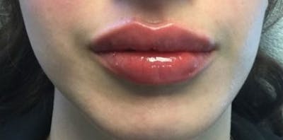 Restylane Before & After Gallery - Patient 100437 - Image 2