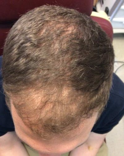 ACP Injections Before & After Gallery - Patient 388577 - Image 1