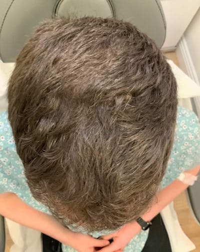 ACP Injections Before & After Gallery - Patient 388577 - Image 2
