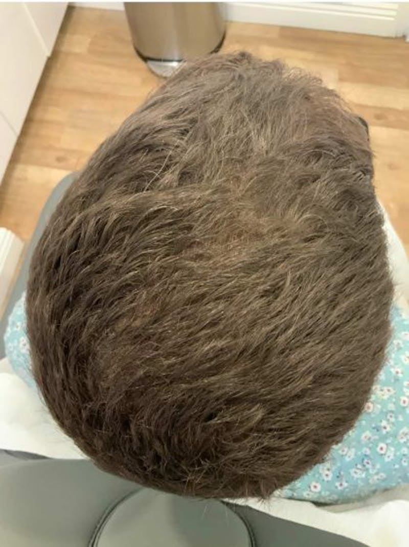 ACP Injections Before & After Gallery - Patient 388577 - Image 3