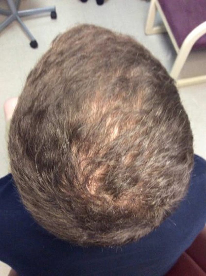 ACP Injections Before & After Gallery - Patient 388577 - Image 4