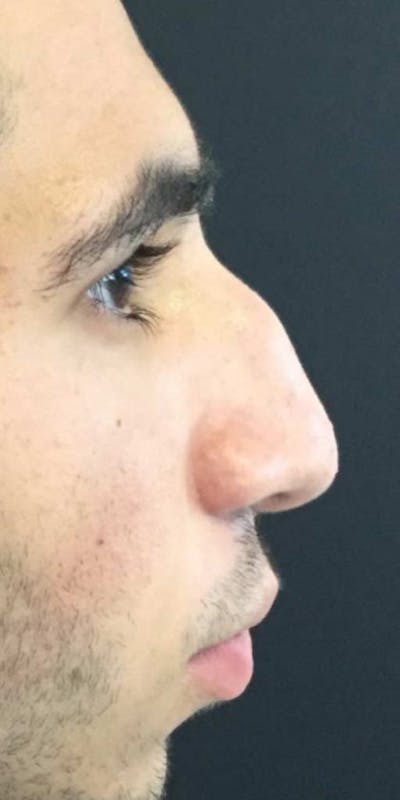 Liquid Rhinoplasty Before & After Gallery - Patient 916007 - Image 1