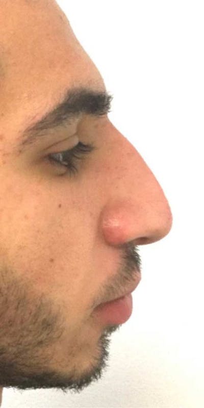 Liquid Rhinoplasty Before & After Gallery - Patient 916007 - Image 2