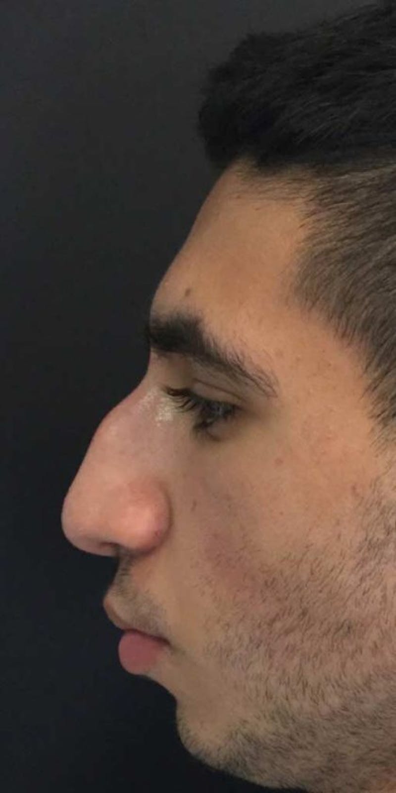 Liquid Rhinoplasty Before & After Gallery - Patient 916007 - Image 3
