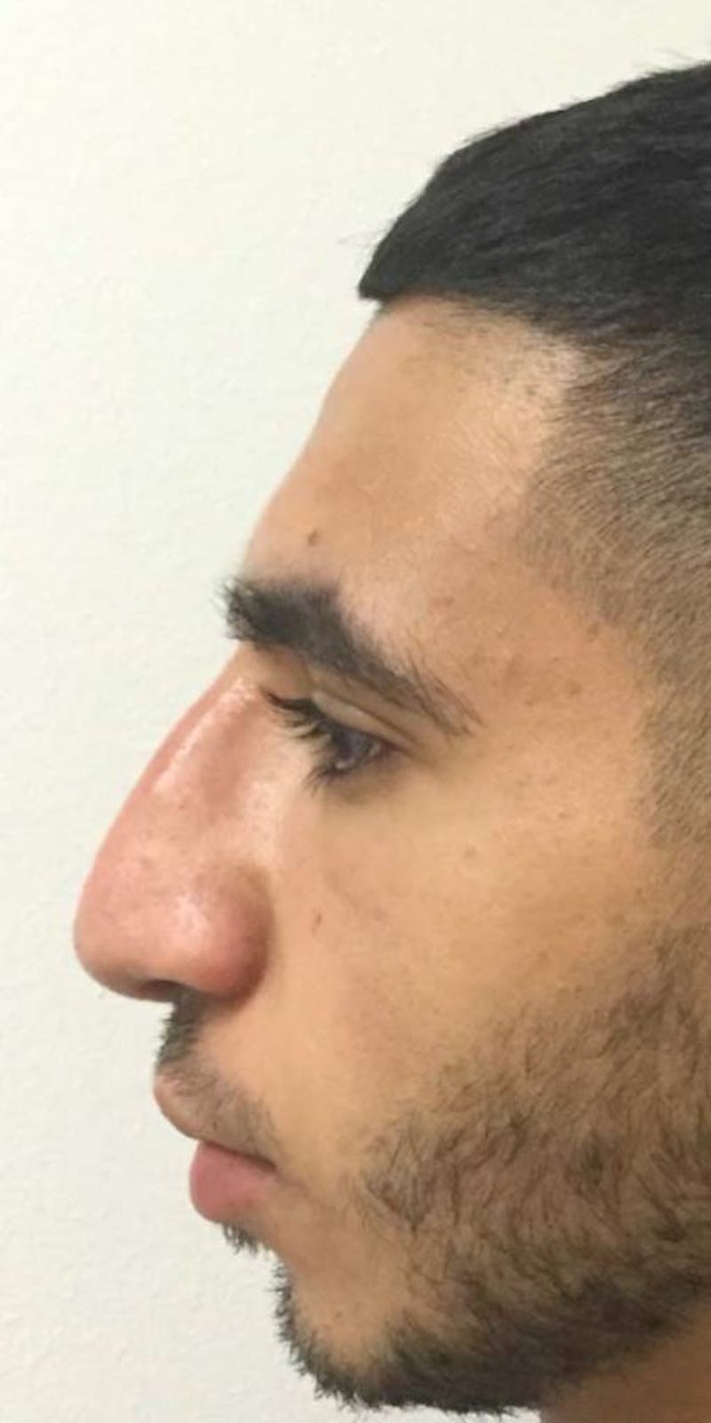 Liquid Rhinoplasty Before & After Gallery - Patient 916007 - Image 4