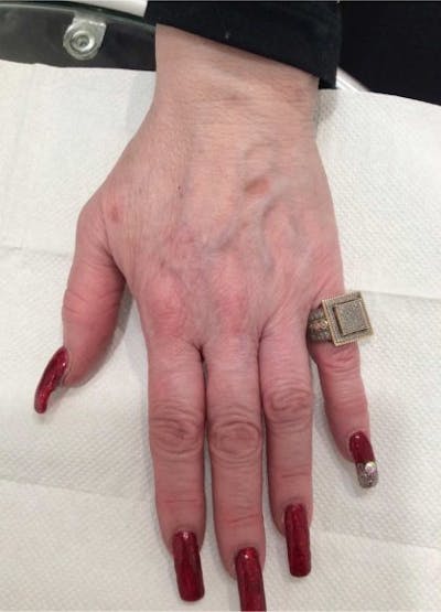 Radiesse Before & After Gallery - Patient 230039 - Image 1