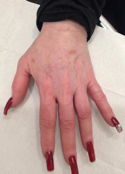 Radiesse Before & After Gallery - Patient 230039 - Image 2