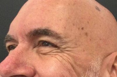 Botox / Dysport Before & After Gallery - Patient 952779 - Image 1