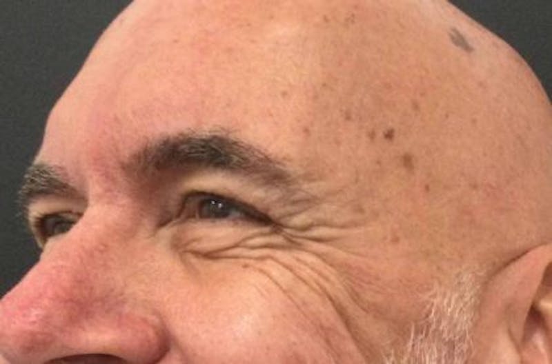 Botox / Dysport Before & After Gallery - Patient 952779 - Image 1