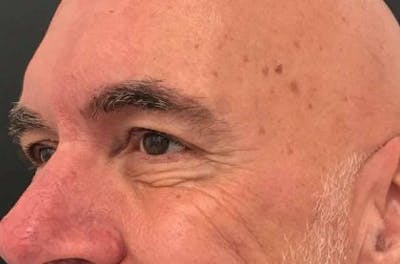 Botox / Dysport Before & After Gallery - Patient 952779 - Image 2