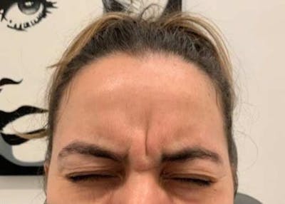 Botox / Dysport Before & After Gallery - Patient 107548 - Image 1