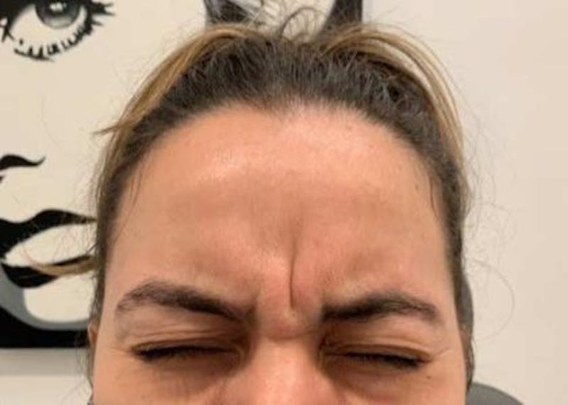 Botox / Dysport Before & After Gallery - Patient 107548 - Image 1