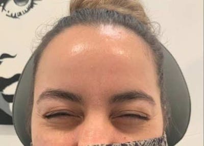 Botox / Dysport Before & After Gallery - Patient 107548 - Image 2