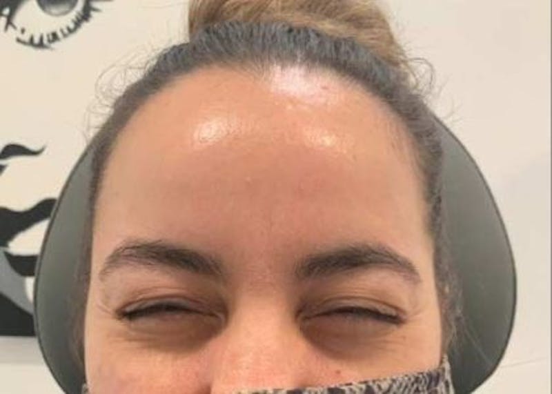 Botox / Dysport Before & After Gallery - Patient 107548 - Image 2