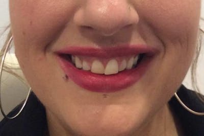 Botox / Dysport Before & After Gallery - Patient 261555 - Image 1
