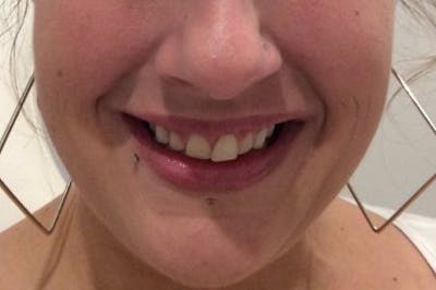 Botox / Dysport Before & After Gallery - Patient 261555 - Image 2