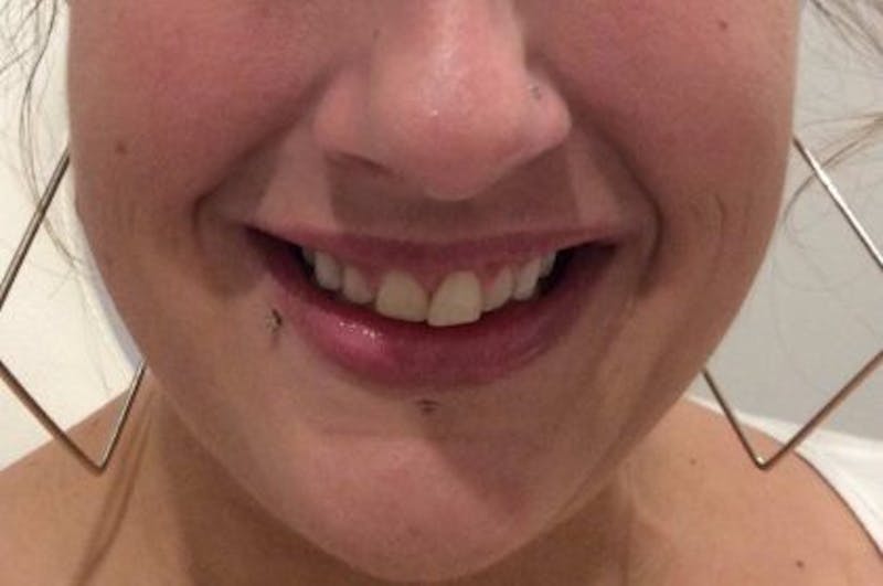 Botox / Dysport Before & After Gallery - Patient 261555 - Image 2