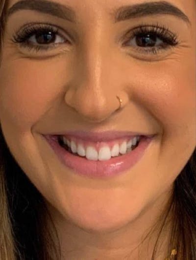 Botox / Dysport Before & After Gallery - Patient 217663 - Image 1