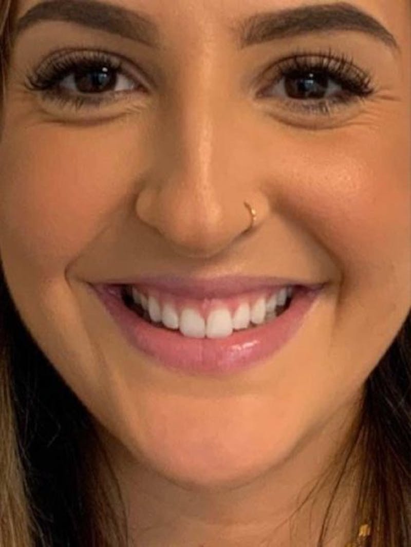 Botox / Dysport Before & After Gallery - Patient 217663 - Image 1